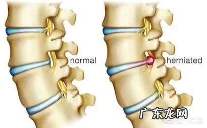 腰间盘突出患者,怎么按摩可以减轻疼痛?