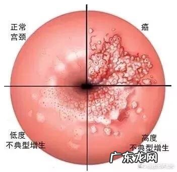每15分钟1位女性死于宫颈癌,如何预防宫颈癌?