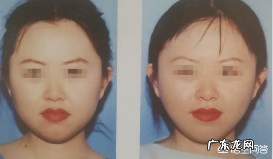 做完吸脂瘦脸手术后的恢复期一般是多久?