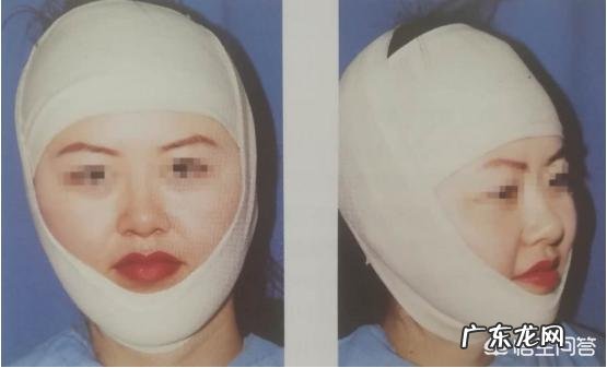 做完吸脂瘦脸手术后的恢复期一般是多久?