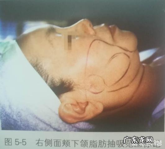 做完吸脂瘦脸手术后的恢复期一般是多久?