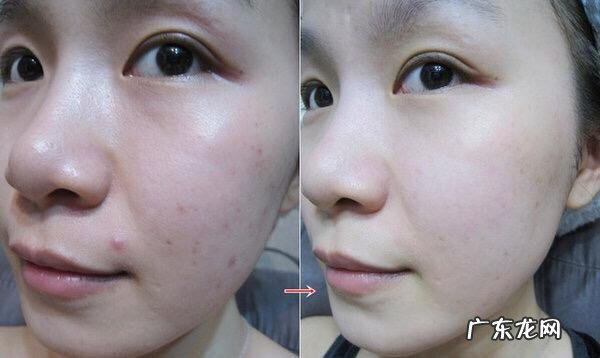 熬夜对皮肤有伤害吗?有缓解的办法吗?