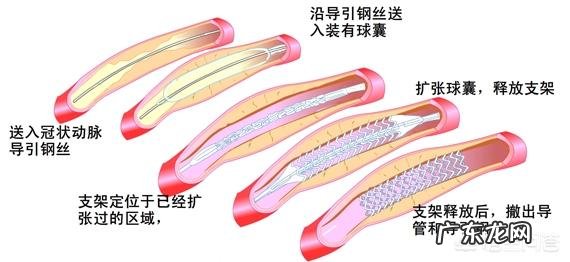 假如父母到癌症晚期zhi不好,要花大价钱延长他们的生命,值得吗?