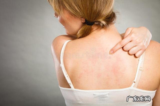 扎完diyi针新冠疫苗身上痒起疹子,怎么办