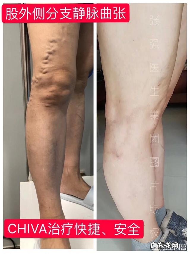 小腿静脉曲张能做减脂运动吗
