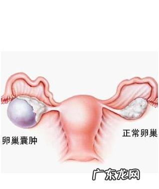 卵巢囊肿都是怎么造成的呢