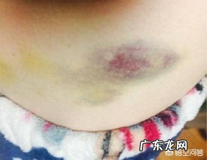 吸脂是什么原理，把脂肪吸出来会有副作用吗？