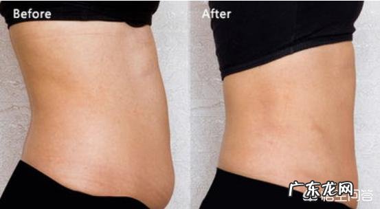 吸脂是什么原理，把脂肪吸出来会有副作用吗？