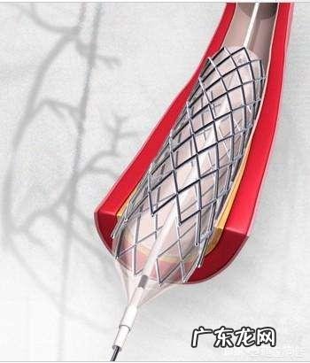 心脏支架术后做哪些运动比较好?有什么注意事项吗?