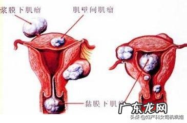 母亲最近检查出了子宫肌瘤，饮食上要注意什么？