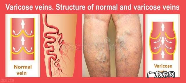 腿上跟蚯蚓一样的，有人说就是静脉曲张了，是这样的吗