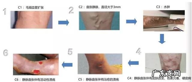 腿上跟蚯蚓一样的，有人说就是静脉曲张了，是这样的吗
