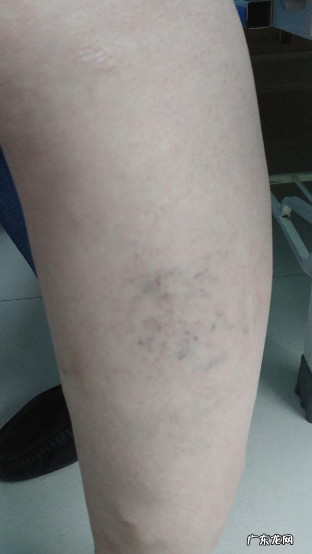 腿上跟蚯蚓一样的，有人说就是静脉曲张了，是这样的吗