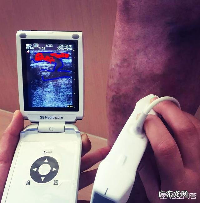 腿上跟蚯蚓一样的，有人说就是静脉曲张了，是这样的吗