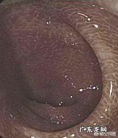 为什么经常吃泻药肠子变黑了？