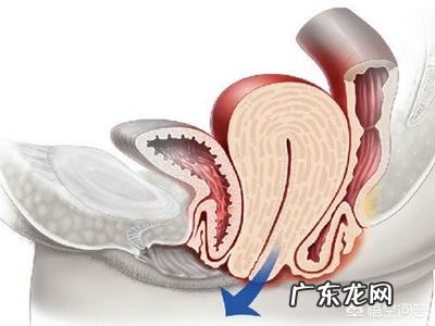 子宫脱垂，做哪些动作有利于恢复？