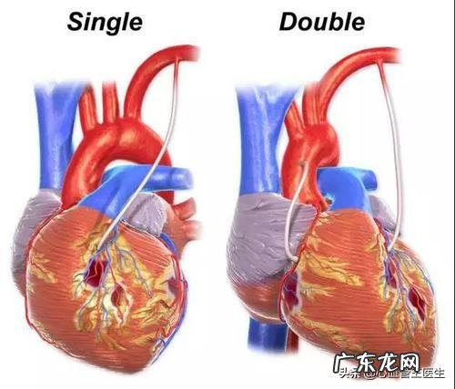 心脏支架有什么代替的吗?