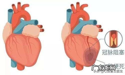 心脏支架有什么代替的吗?