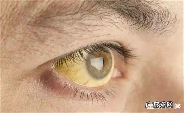 失眠、口干都说是肝火旺,怎么快速降肝火?