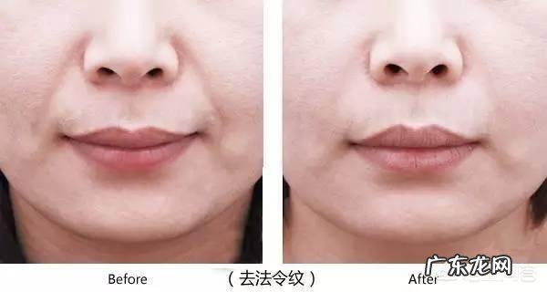 自体脂肪填充填充法令纹后怎么护理?