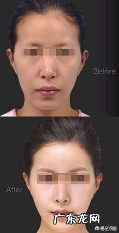 全脸脂肪填充后老了会怎么样?