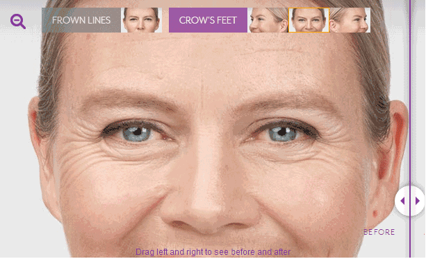 多久可以看出瘦脸针瘦脸的效果