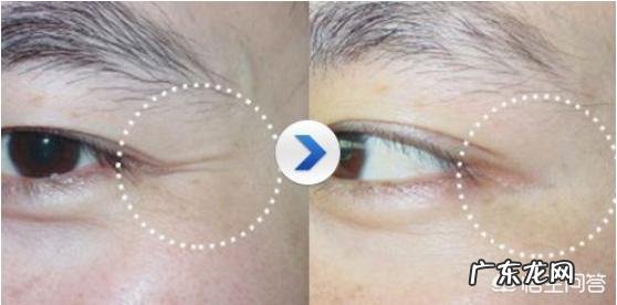 多久可以看出瘦脸针瘦脸的效果