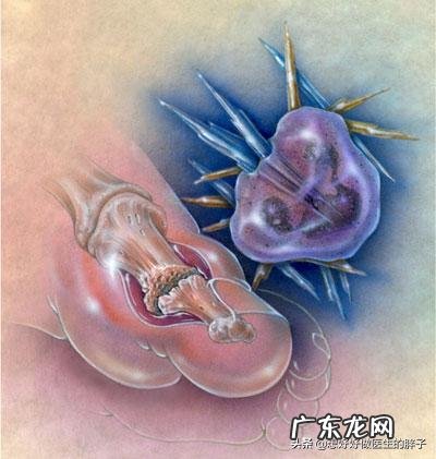 都说痛风患者,想要量尿酸先控制体重,是真的吗?