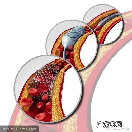 血管里装支架后平均能用多少年?