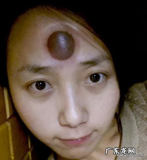 血压高。颈椎疼。头疼。可以额头上拔火罐吗
