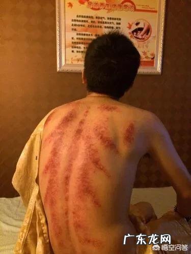 刮痧和拔火罐哪个效果更好