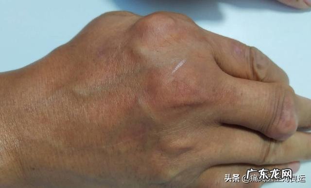 灵魂拷问,如何面对一个超ji肥胖,浑身长满痛风石不卫生的丈夫?