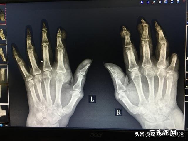 灵魂拷问,如何面对一个超ji肥胖,浑身长满痛风石不卫生的丈夫?