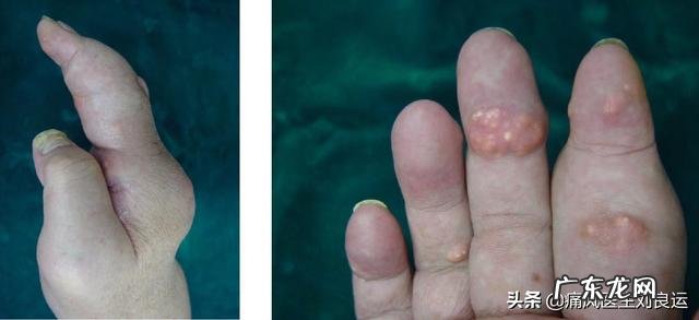 灵魂拷问,如何面对一个超ji肥胖,浑身长满痛风石不卫生的丈夫?