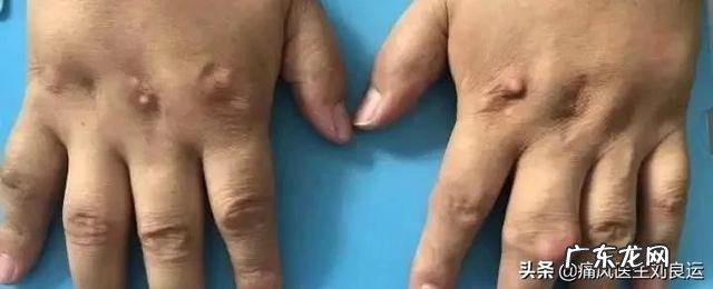 灵魂拷问，如何面对一个超ji肥胖，浑身长满痛风石不卫生的丈夫？