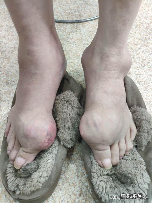 灵魂拷问，如何面对一个超ji肥胖，浑身长满痛风石不卫生的丈夫？