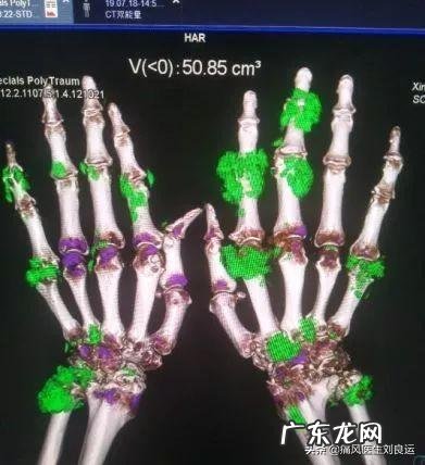 灵魂拷问,如何面对一个超ji肥胖,浑身长满痛风石不卫生的丈夫?