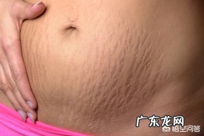 妊娠纹是怀孕之后才会有的吗？