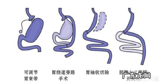 除了节食和运动减肥外,还有没有其他方法