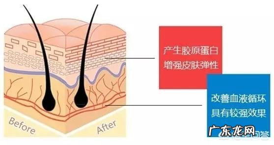 妊娠纹会自己消失吗？要怎样处理妊娠纹呢？