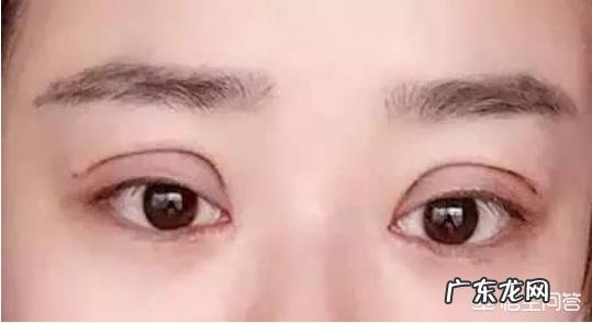最早一批做双眼皮手术的人怎么样了?