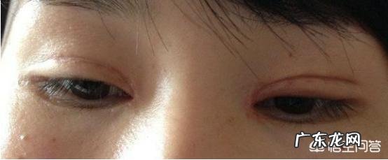 最早一批做双眼皮手术的人怎么样了?