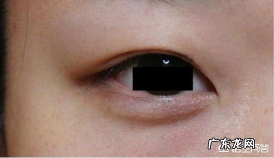 最早一批做双眼皮手术的人怎么样了?