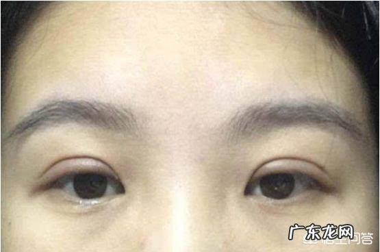 最早一批做双眼皮手术的人怎么样了?