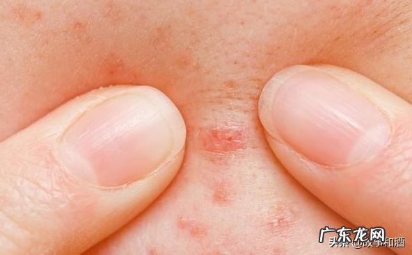 熬夜肝火旺，长痘，还有点口臭，喝什么茶可以降肝火？