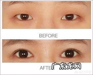 割了双眼皮,怎么眼睛形状都改变了呢,变成了吊眼,好?