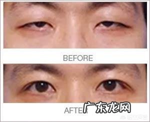 割了双眼皮，怎么眼睛形状都改变了呢，变成了吊眼，好？