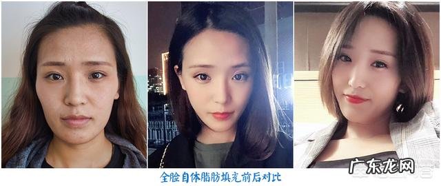 自体脂肪填充后,皮肤为什么会变好?