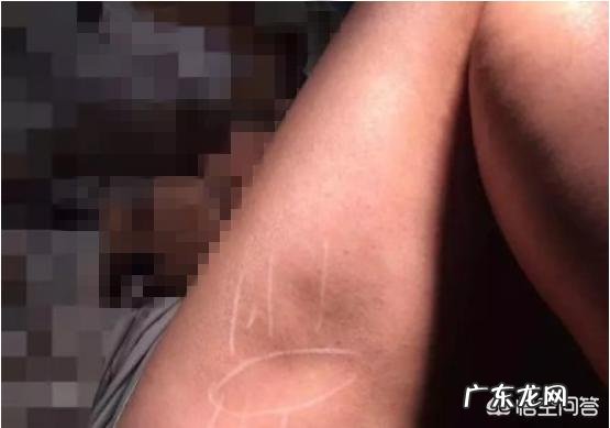 抽脂减肥有危害吗会不会反弹