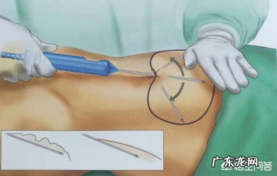 抽脂减肥有危害吗会不会反弹